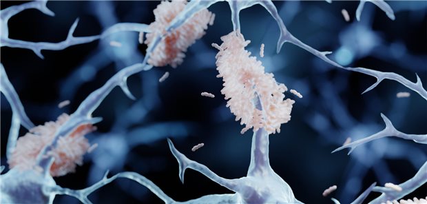 beta-Amyloid an den Neuronen